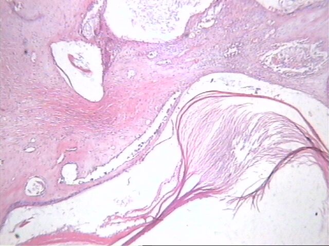 Fig. 4  Quistes crneos en un phyllodes benigno - <div style=